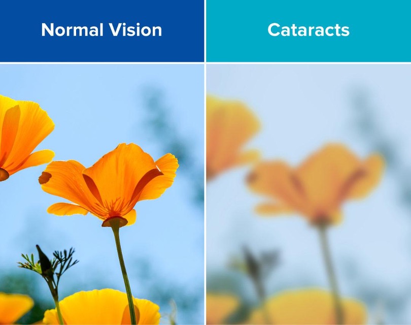 Side-by-side comparison of the same orange flowers seen with normal vision and through a cataract, where colour and detail are washed out